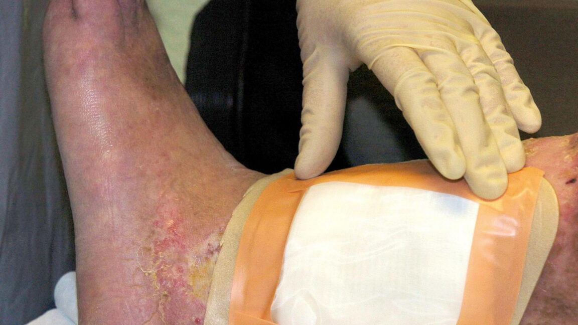 Second carcass-eating fly species cleared by FDA for maggot wound therapy – Neue Optionen für die Maggot Therapy
